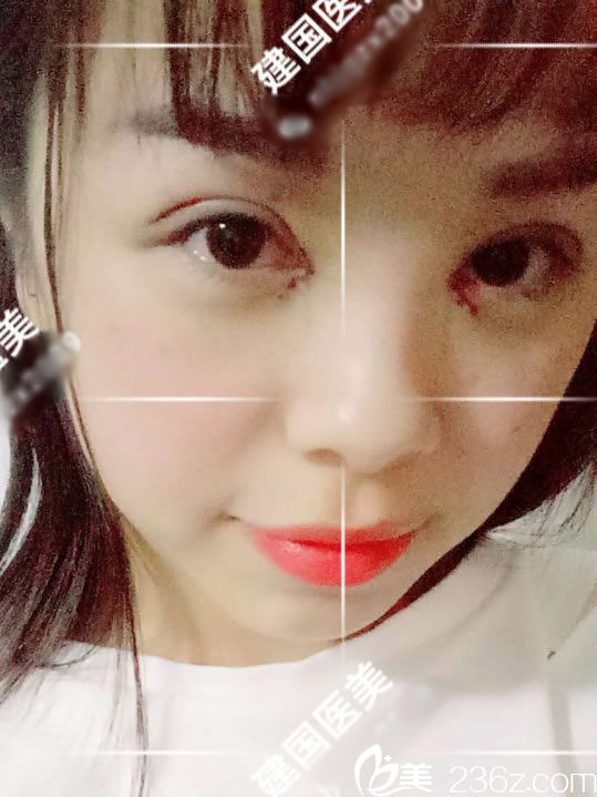 做全切雙眼皮手術(shù)當(dāng)天照片 做全切雙眼皮手術(shù)當(dāng)天照片