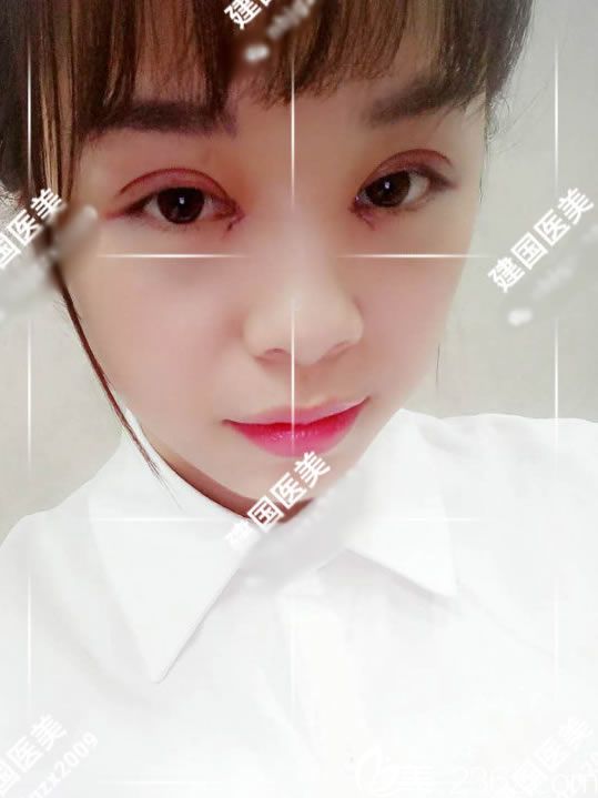 木木做雙眼皮手術(shù)第2天 木木做雙眼皮手術(shù)第2天