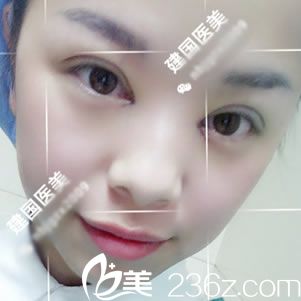寧波誰做雙眼皮好？小仙女找徐林杰院長做雙眼皮三天的蛻變過程