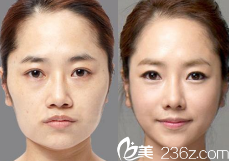 四川達(dá)州雙均整形美容醫(yī)院注射瘦臉的手術(shù)案例