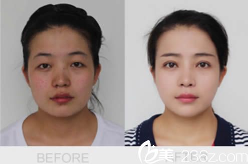 白莉雙眼皮案例 白莉雙眼皮案例