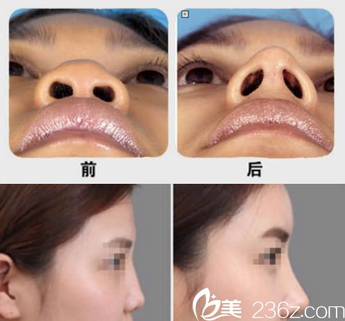 醫(yī)生鼻尖整形對(duì)比圖 醫(yī)生鼻尖整形對(duì)比圖