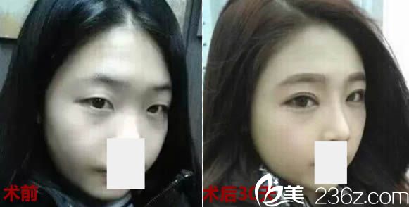 來看整形做的隆鼻+雙眼皮效果咋樣