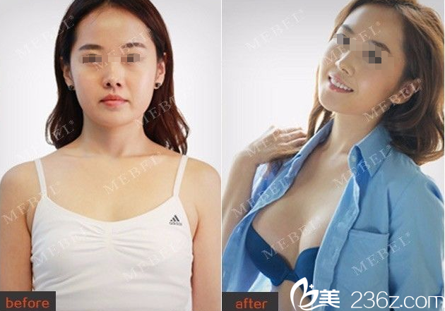 譚亮主任隆胸案例 譚亮主任隆胸案例