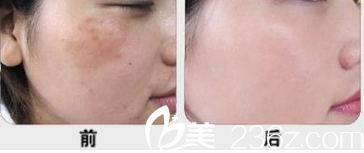 北京圣嘉新顧生祛斑案例