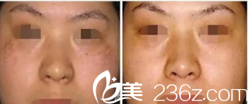 北京圣嘉新祛斑美膚案例