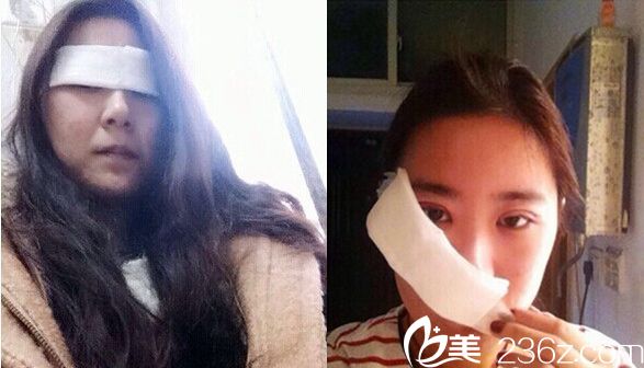 切開法雙眼皮術(shù)后恢復天 切開法雙眼皮術(shù)后恢復天