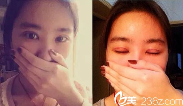 雙眼皮術(shù)后第四天恢復 雙眼皮術(shù)后第四天恢復