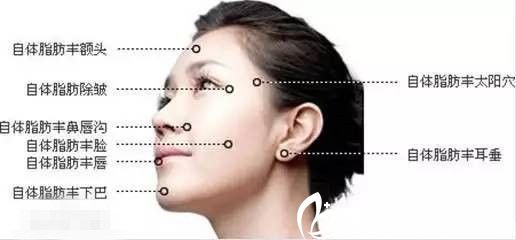自體脂肪手術(shù)填充的部位