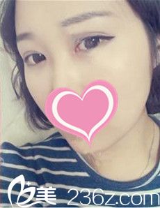 術(shù)后7天雙眼皮樣子