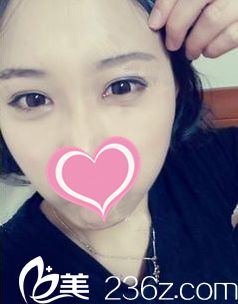 韓式雙眼皮術(shù)后15天恢復(fù)情況