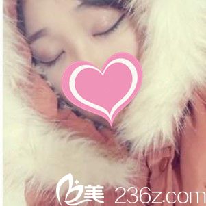 術(shù)后1個月雙眼皮閉眼無痕