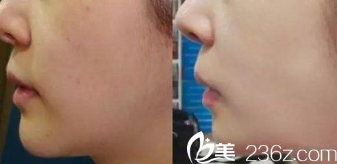 注射真人案例對比圖