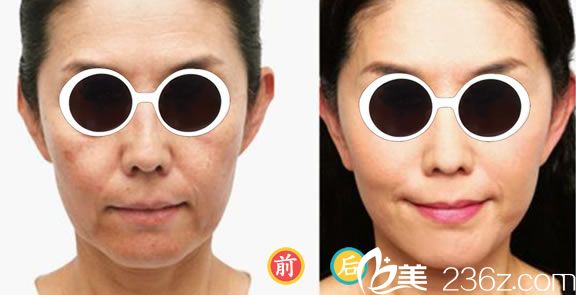 張躍偉醫(yī)生的面部年輪化<span style=