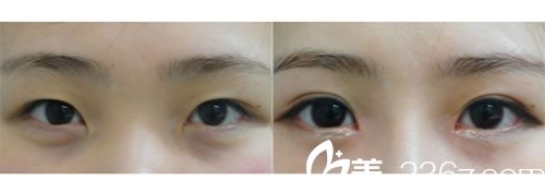 韓國江南三星整形醫(yī)院  內(nèi)雙變外雙對比圖