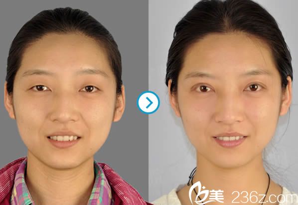 馮守運(yùn)雙眼皮案例圖