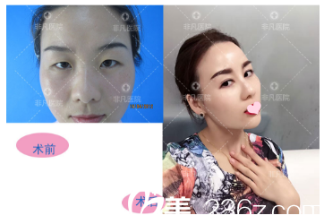 深圳非凡整形醫(yī)院易培金雙眼皮案例