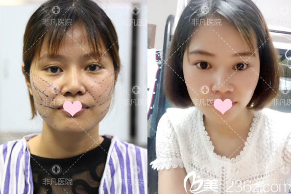 深圳非凡整形醫(yī)院王永祥面部線雕提升案例