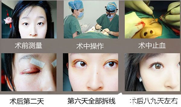 壹加壹分切雙眼皮手術(shù)過程