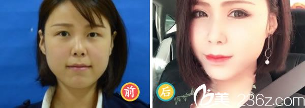 壹加壹雙眼皮手術(shù)<span style=