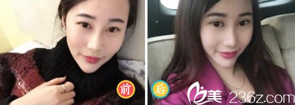 全切雙眼皮50天的恢復(fù)<span style=