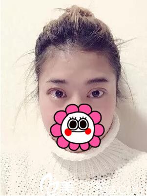 做完切開雙眼皮后眼好腫 做完切開雙眼皮后眼好腫