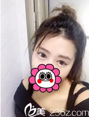 武漢洪山愛美匯瞿敏切開雙眼皮案例 對雙眼皮貼說再見