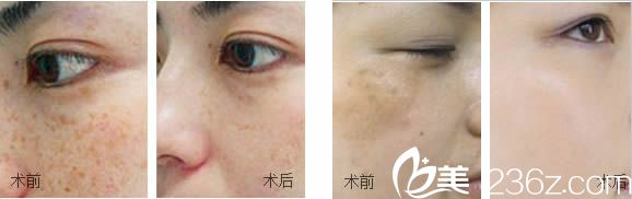 馬志軍祛斑案例圖 馬志軍祛斑案例圖