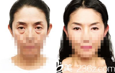 祛眼袋前后對(duì)比圖