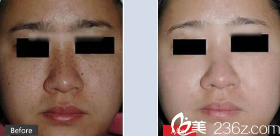 閆侯旺祛斑前后對比案例
