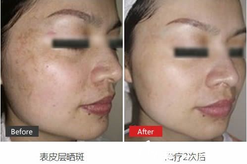 王瑩治療曬斑案例效果對比圖