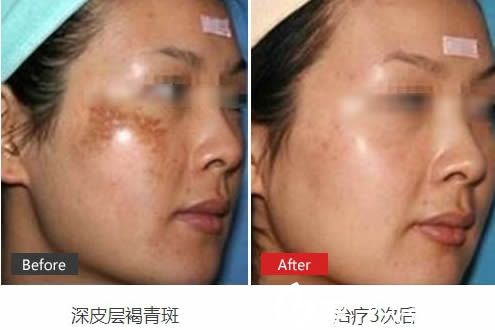 王瑩治療深皮層褐青斑3次術后效果圖