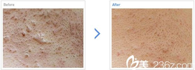 激光去除痤瘡疤痕治療前后對比照片