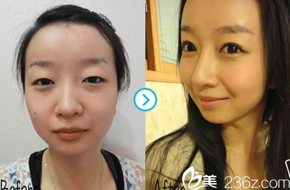 陳秀芳雙眼皮和假體隆鼻案例效果圖 陳秀芳雙眼皮和假體隆鼻案例效果圖