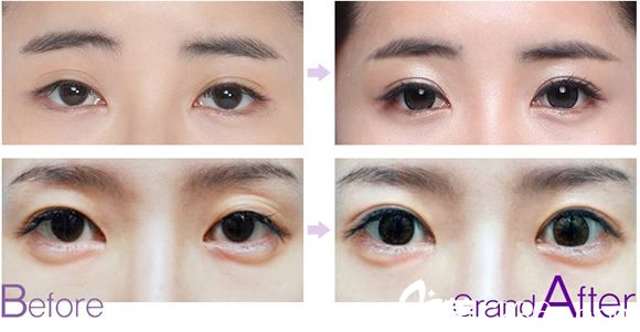眼睛修復(fù)手術(shù)前后對(duì)比照片