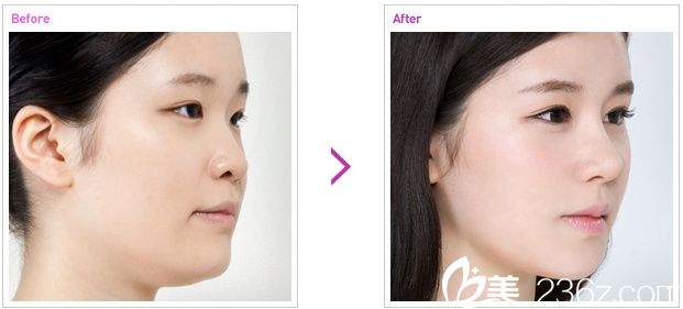 名品鼻子整形前后照片 名品鼻子整形前后照片