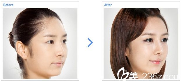 額頭脂肪移植手術前后圖 額頭脂肪移植手術前后圖