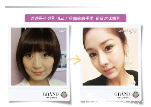 臉部輪廓手術前后照片 臉部輪廓手術前后照片