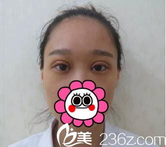 術(shù)后6天效果 術(shù)后6天效果