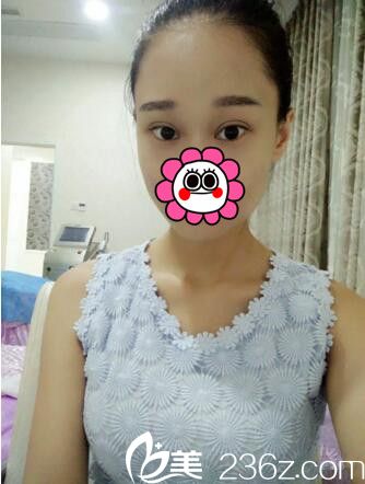 術(shù)后14天效果 術(shù)后14天效果