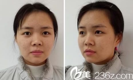 在瑞麗做鼻綜合前的素顏照片 在瑞麗做鼻綜合前的素顏照片