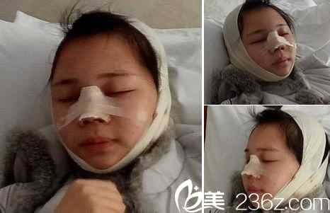 做完鼻綜合手術(shù)當(dāng)天照片 做完鼻綜合手術(shù)當(dāng)天照片