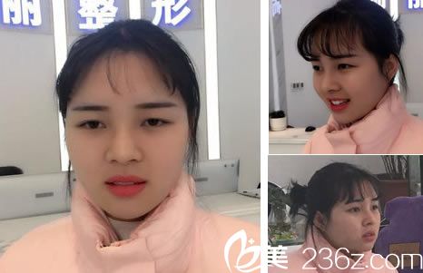 耳軟骨隆鼻手術(shù)15天效果 耳軟骨隆鼻手術(shù)15天效果