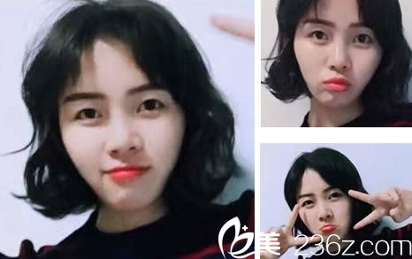 金華瑞麗做鼻綜合效果怎么樣 金華瑞麗做鼻綜合效果怎么樣