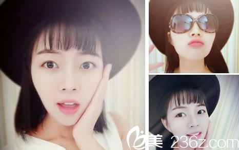 自體軟骨隆鼻手術(shù)60天恢復(fù)照片 自體軟骨隆鼻手術(shù)60天恢復(fù)照片