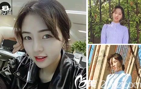 鼻綜合整形手術(shù)80天效果怎么樣 鼻綜合整形手術(shù)80天效果怎么樣