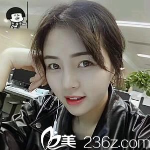 金華瑞麗整形好嗎？【真人案例】鄰家小妹分享做鼻綜合80天效果與恢復(fù)過程圖