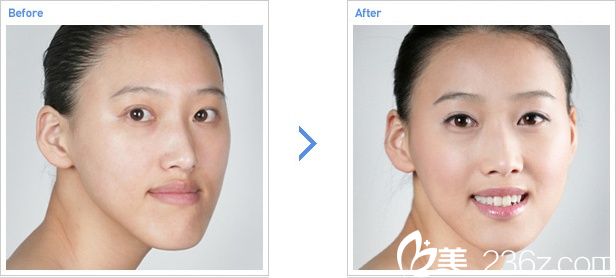 兩顎手術(shù)前后對(duì)比照片