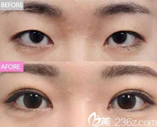 雙眼皮手術(shù)改善倒睫