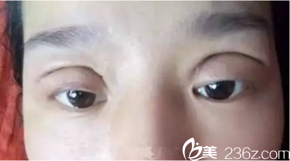 大寬雙眼皮寬出天際